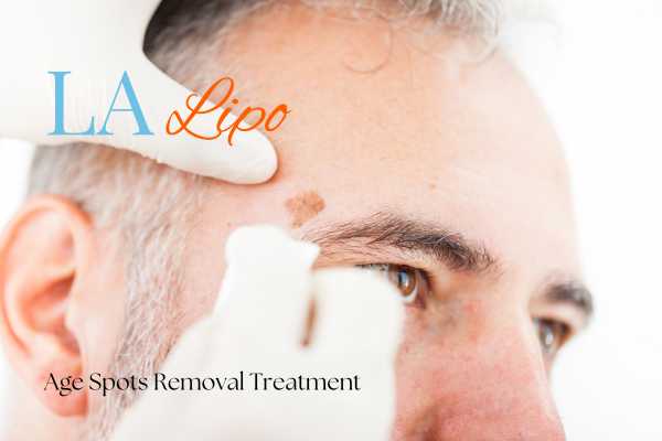 What Are the Most Effective Treatments for Age Spots Surrey?