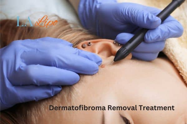 Dermatofibroma Removal Treatment Surrey