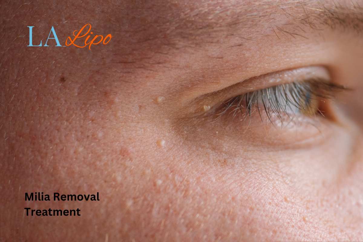 Cryopen Milia Removal: Is It the Easiest and Safest Option Surrey?