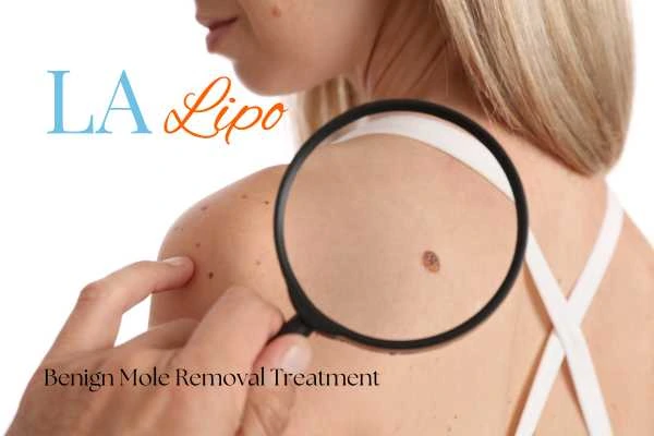 Why getting moles removed Surrey can boost your confidence!