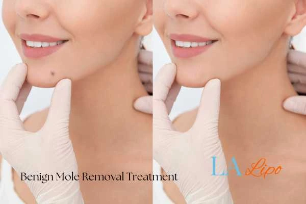 Woman's before and after results of being moles removal treatment Surrey
