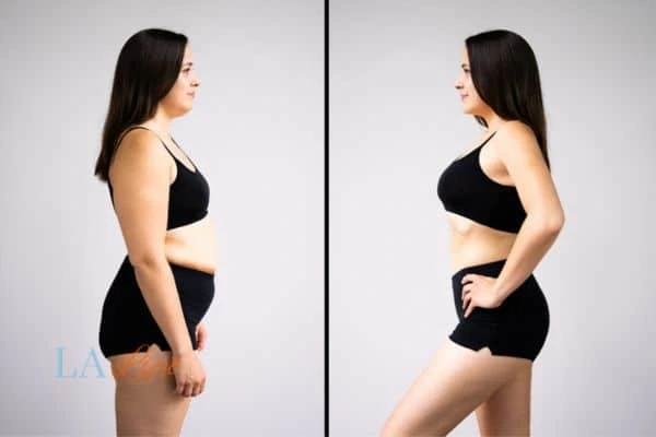 image of woman before and after results of LA-EMS Body Sculpting Surrey to help treat Diastasis recti