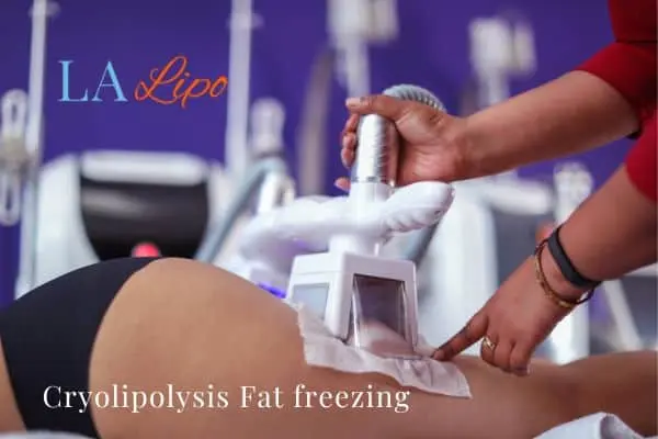 women getting fat freezing Surrey