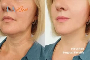 hi-fu for wrinkles Surrey before and after results