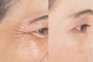 Before and after results of woman - HI-fu wrinkles reduction treatment Surrey