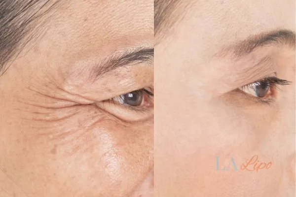 Before and after results of woman - HI-fu wrinkles reduction treatment Surrey
