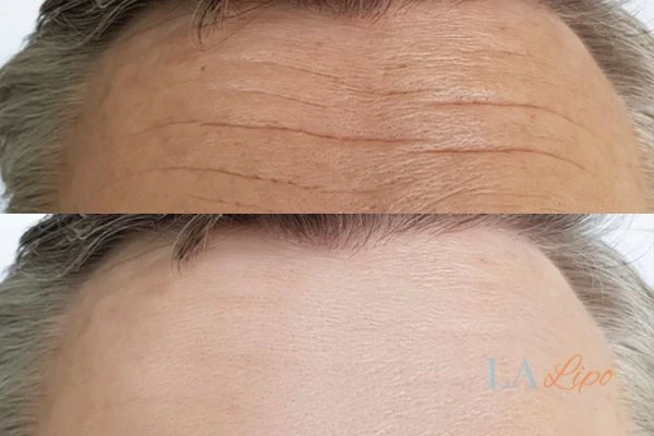 results of HIFU Surrey on mans forehead to help reduce lines and wrinkles