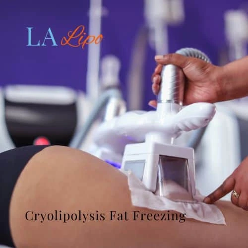 fat freezing - Cryolipolysis Surrey