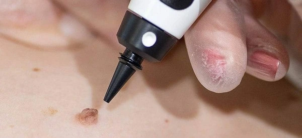 skin tag removal using cryopen Surrey