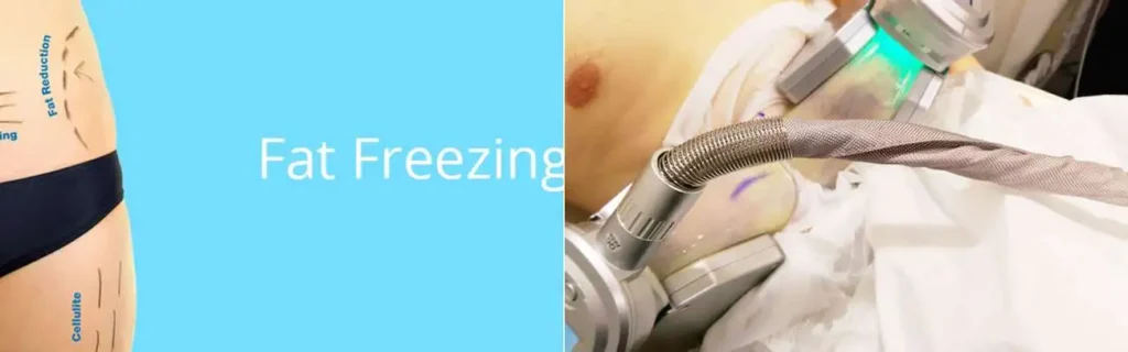 multi areas of a persons body having coolsculpting Surrey treatment