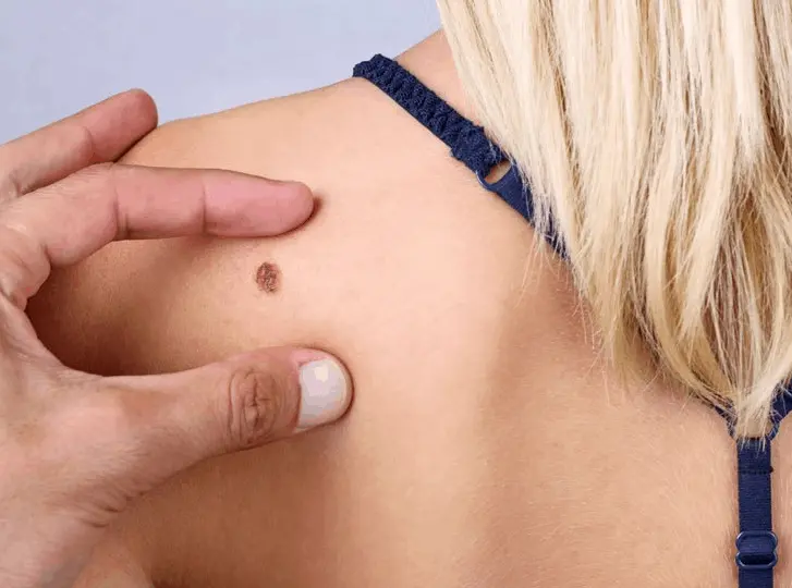 woman having mole removal Surrey consultation before treatment.