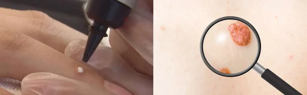 Cryopen for mole removal Surrey - speak to our team today!