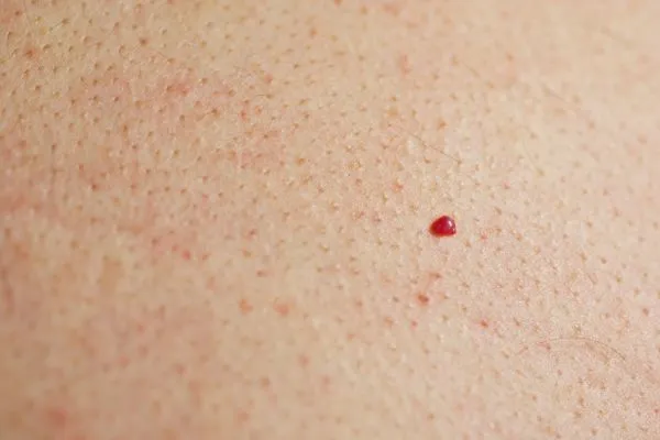 close up of a cherry angioma Surrey