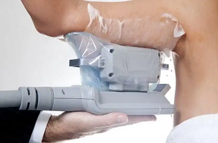 Picture of fat freezing Surrey on the upper arms.