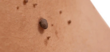 image of a skin tag Surrey