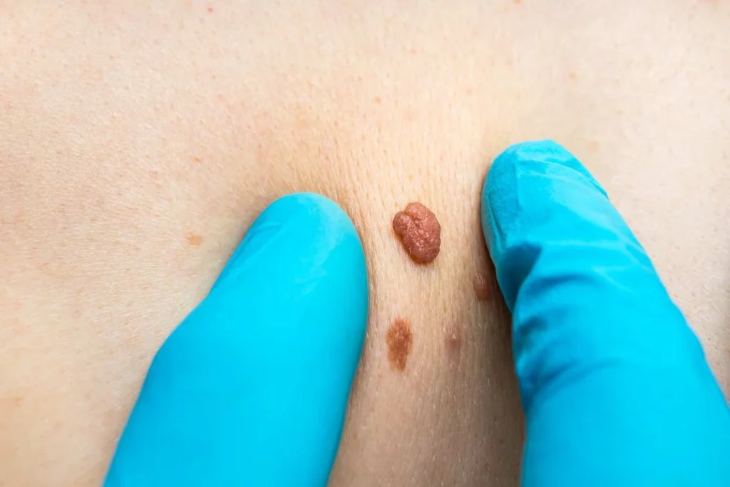 Consultant examining a skin tag Surrey