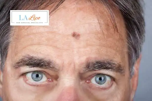Solar Lentigo Removal Surrey image of man with mark on his forehead