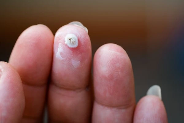 wart on person finger - cryotherapy to treat from LA LIPO Surrey