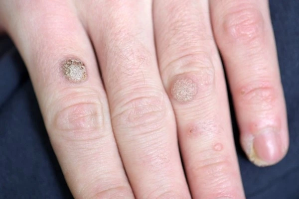 photo of warts on person hand - see wart removal Surrey from LA LIPO