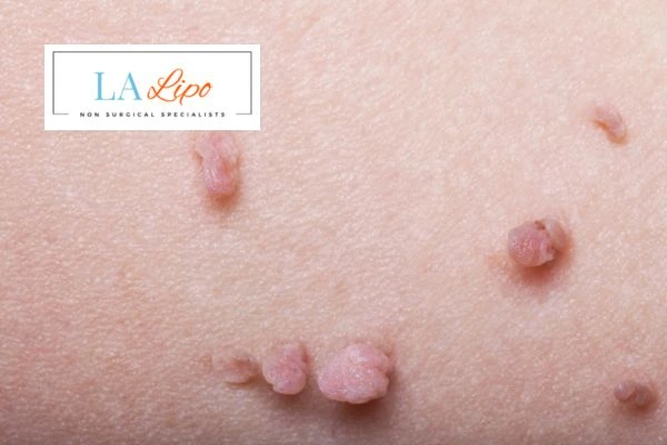 Does cryopen skin tag removal Surrey hurt? Find out now call our team today!