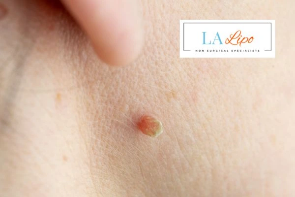 Book skin tag removal Surrey today speak to our team now!