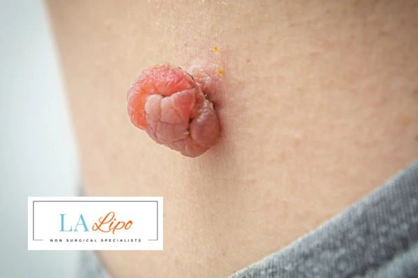 Interested in skin tag removal Surrey? Concerned about the pain? Find out more today!