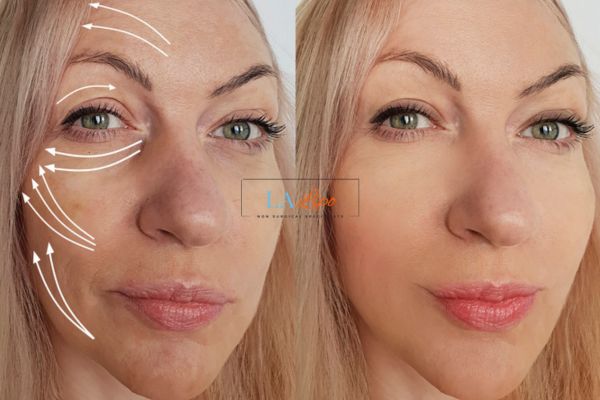 Morpheus 8 results Surrey face lift.