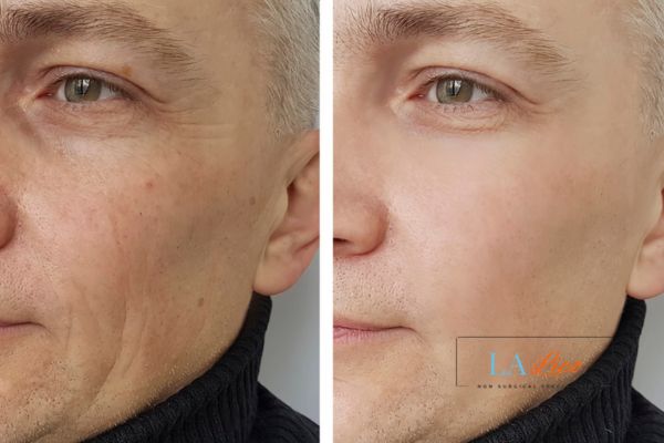 See the amazing results of Morpheus8 Treatment Surrey!