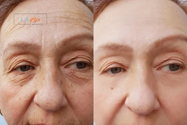 The powerful benefits of Morpheus8 Treatment Surrey - Call Our team today!