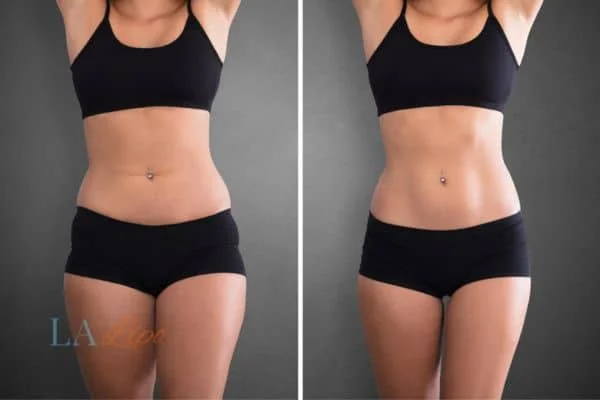 before and after results of non-surgical treatment to help a woman's body image and mental health Surrey
