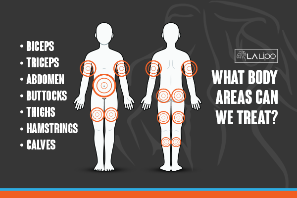Diagram to show areas you can have LA-EMS Body Sculpting Treatment Surrey