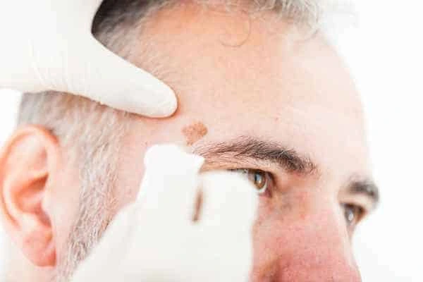 Age spots and elderly people Surrey what is the link?