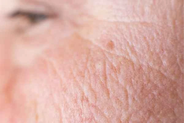 close up picture of a woman's face showing an age spot Surrey