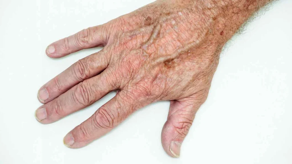 Male hand showing age spot Surrey