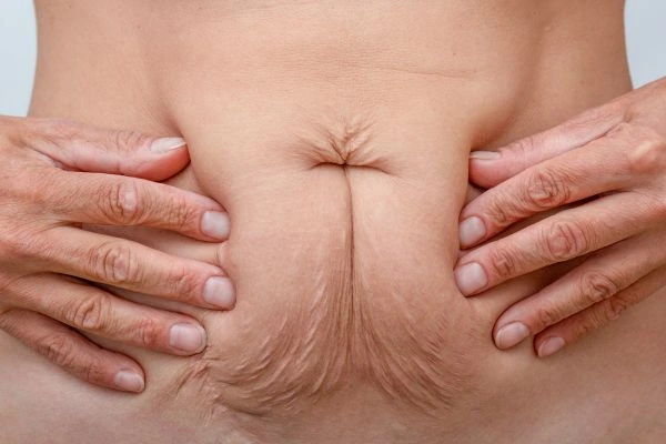 Image of a woman's stomach with loose skin - example of skin tightening Surrey options