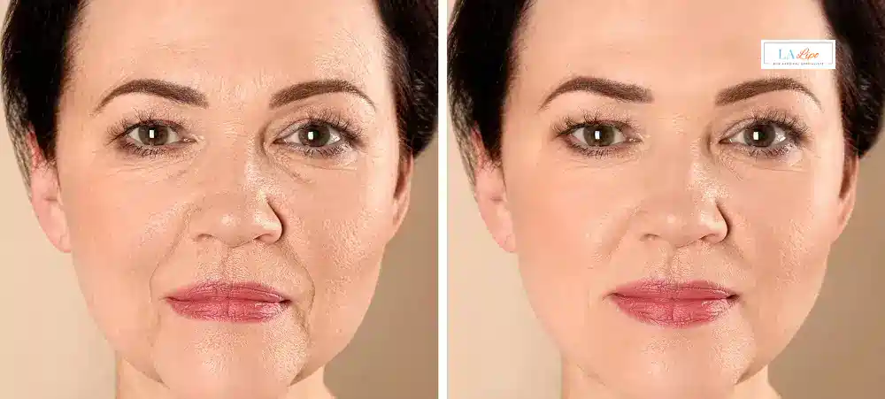 How Long Does It Take to See Results and How Long Do They Last Surrey?
